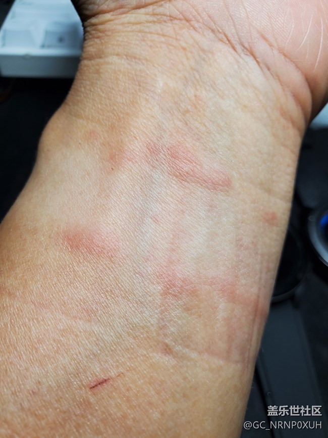 Galaxy Watch4表帶有疑似過(guò)敏現(xiàn)象