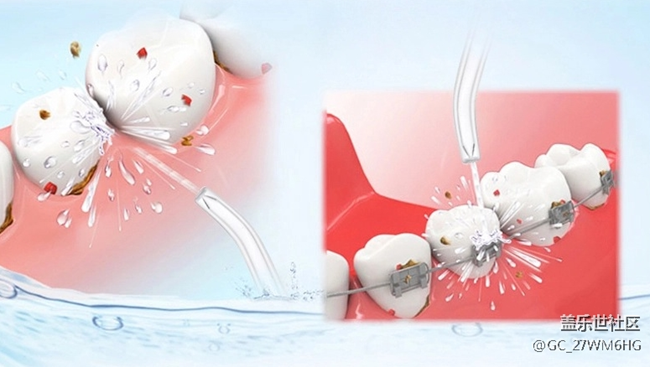 沖牙器的危害和弊端有哪些，護(hù)理師盤(pán)點(diǎn)四大傷牙原因！