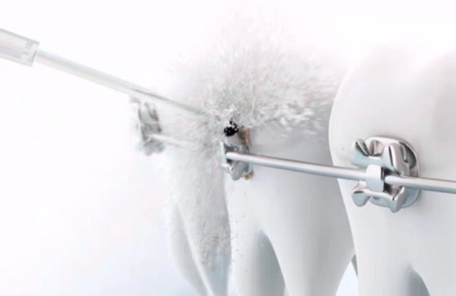 戴牙套可以用沖牙器嗎？警戒三大傷牙危害！