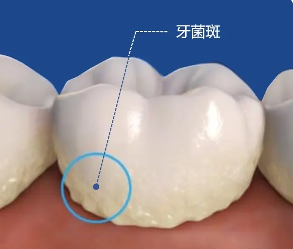 電動牙刷該如何選購？博主提醒四大危害誤區(qū)不得不防