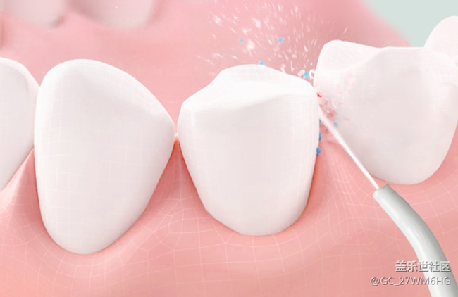 戴牙套建議用沖牙器嗎？務必留心三大傷牙弊端！