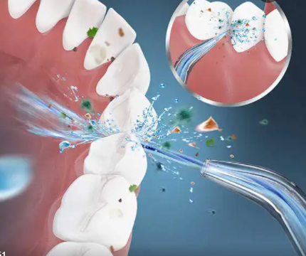 牙齒矯正可以用沖牙器嗎？博主科普四大誤區(qū)