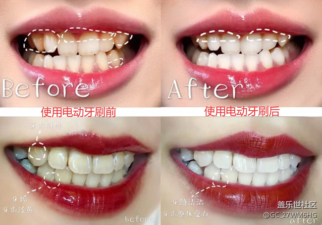 使用電動(dòng)牙刷有什么危害？科普四大禁忌