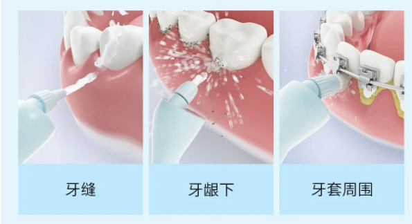 如何正確選購沖牙器？四大傷牙誤區(qū)要警惕！