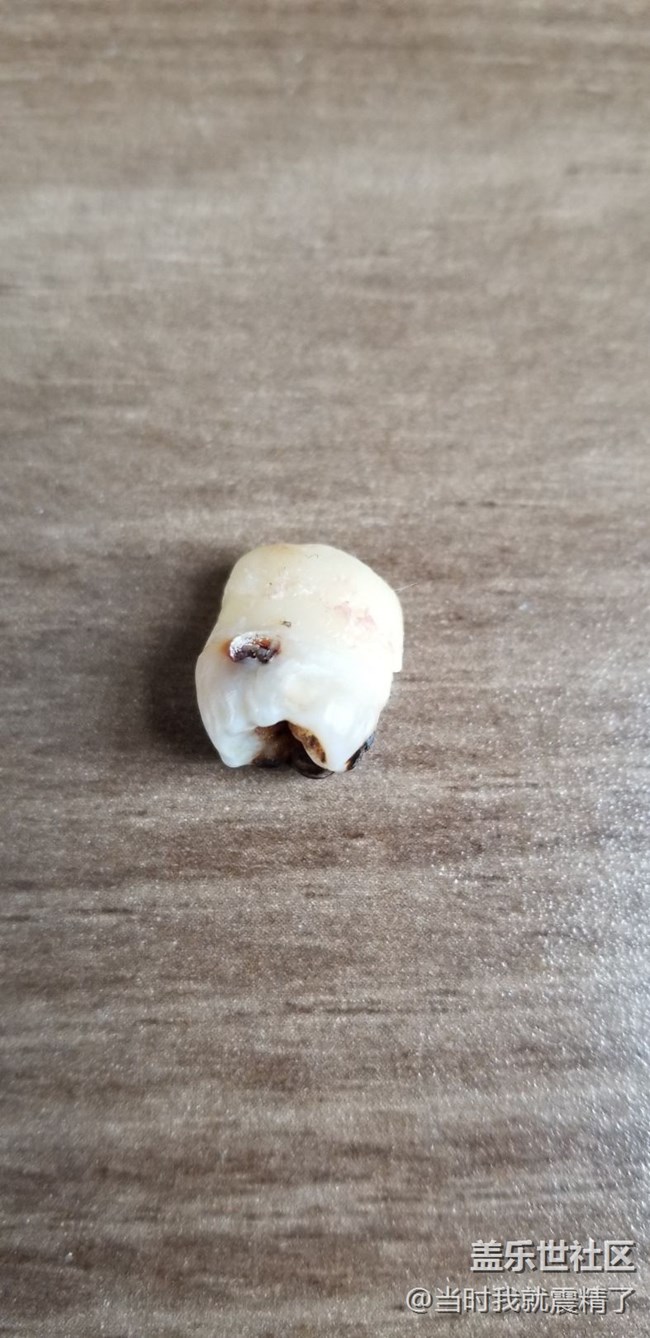 拔了一顆智齒，大圖伺候~